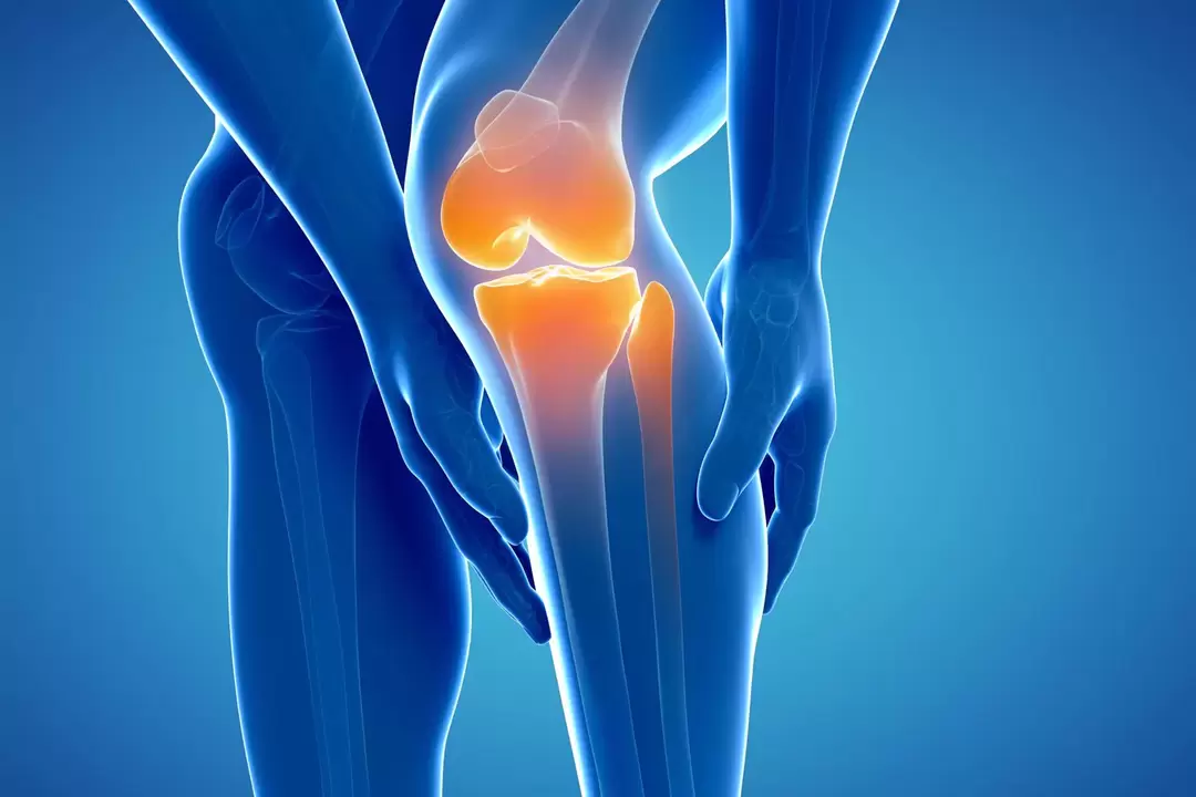 Artrose van het kniegewricht (gonartrose, vervormende artrose)