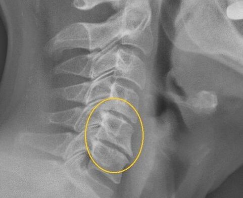 Osteochondrose van de cervicale wervelkolom op een X -RAY