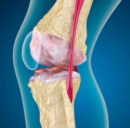 Arthrosose van het kniegewricht