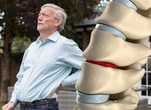 Osteochondrose tast de tussenwervelschijven aan en veroorzaakt rugpijn